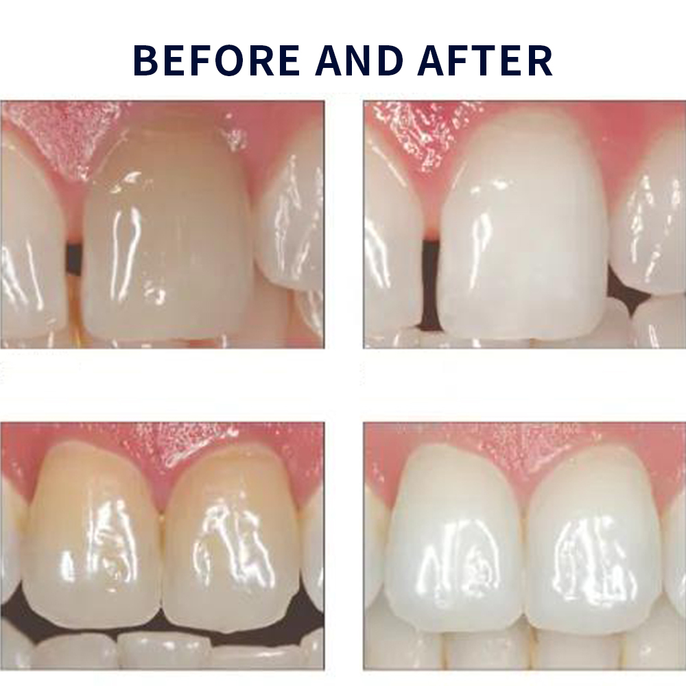 Opale scence White ning 1,2 pf – Teeth Whitening Near Me Bewertung und Preis
