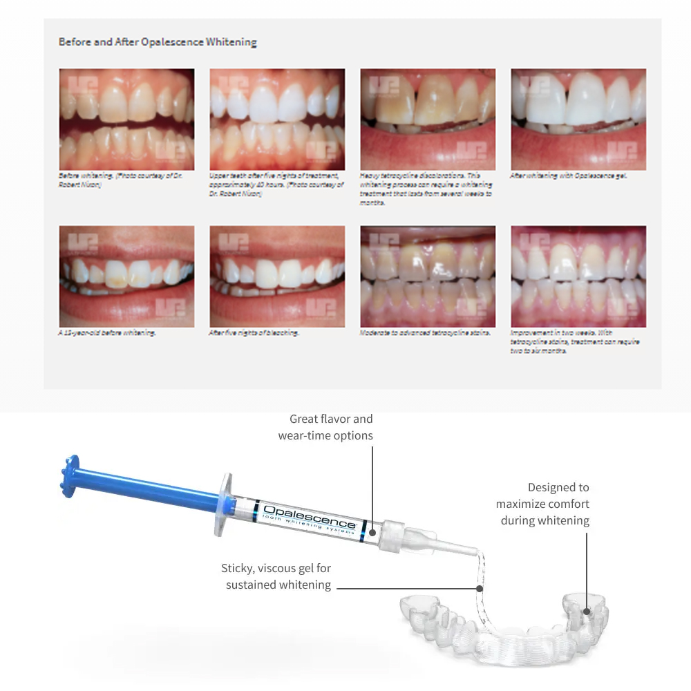 Opale scence White ning 1,2 pf – Teeth Whitening Near Me Bewertung und Preis